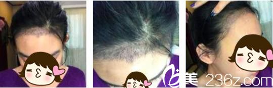 韓國Bozar毛發(fā)移植中心裴強益發(fā)際線種植真人案例術(shù)后第七天