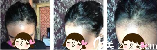 韓國Bozar毛發(fā)移植中心裴強益發(fā)際線種植真人案例術(shù)后一個月