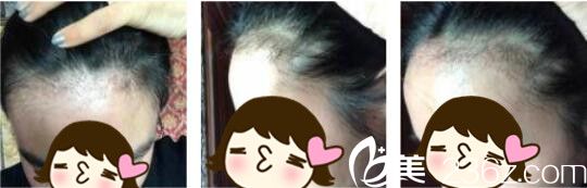 韓國Bozar毛發(fā)移植中心裴強益發(fā)際線種植真人案例術(shù)后三個月