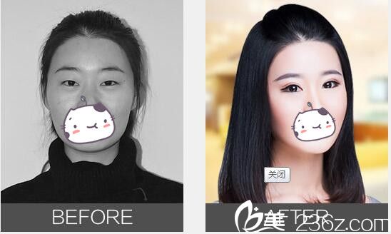 單眼皮、瞇瞇眼、上瞼無力在無錫麗都做雙眼皮