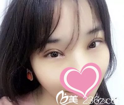 許言午雙眼皮手術(shù)案例