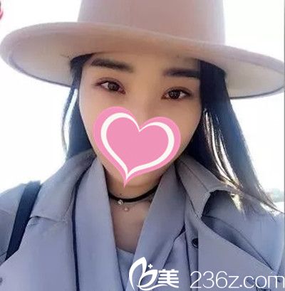 過年在九江臺美做了雙眼皮手術(shù)，算是擺脫了瞇瞇眼