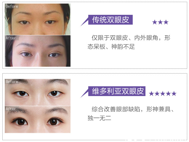 在南京維多利亞做雙眼皮案例 在南京維多利亞做雙眼皮案例