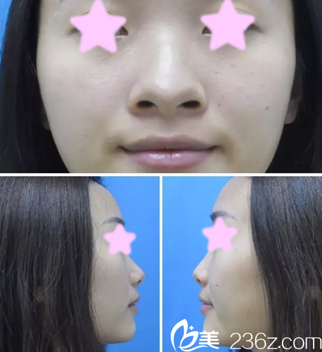 我在大同清木整形醫(yī)院做隆鼻前的照片 我在大同清木整形醫(yī)院做隆鼻前的照片