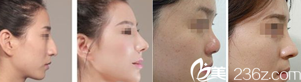 假體隆鼻案例效果對比圖