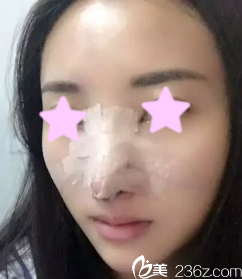 我在大同清木做自體肋骨隆鼻后第5天照片 我在大同清木做自體肋骨隆鼻后第5天照片