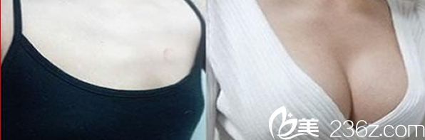 自體脂肪隆胸代表案例