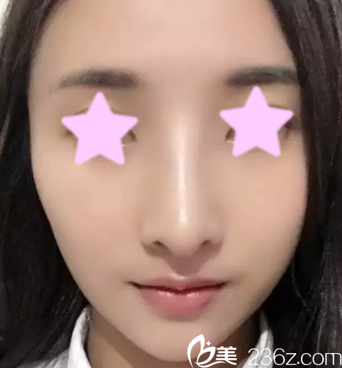 今天給大家說說我一個月前在大同清木整形做自體肋骨隆鼻個人經歷