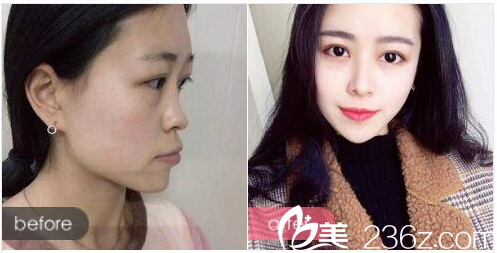 廣州曙光張元龍醫(yī)生做的隆鼻案例