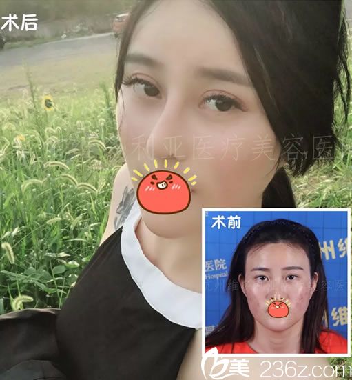 杭州維多利亞周長(zhǎng)兵雙眼皮和隆鼻案例 杭州維多利亞周長(zhǎng)兵雙眼皮和隆鼻案例