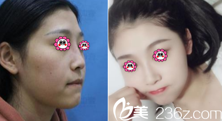 北京壹加壹王珂隆鼻案例 北京壹加壹王珂隆鼻案例