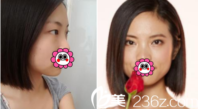 北京壹加壹王珂雙眼皮案例 北京壹加壹王珂雙眼皮案例