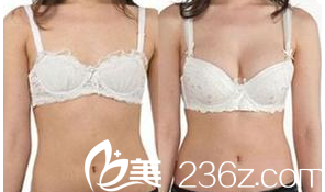 北京壹加壹王珂脂肪豐胸案例 北京壹加壹王珂脂肪豐胸案例