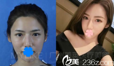 廣州美萊整形面部填充效果圖 廣州美萊整形面部填充效果圖