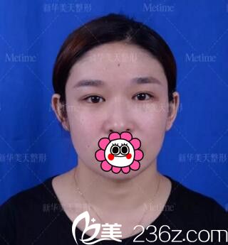 做眼鼻綜合手術(shù)術(shù)前照 做眼鼻綜合手術(shù)術(shù)前照