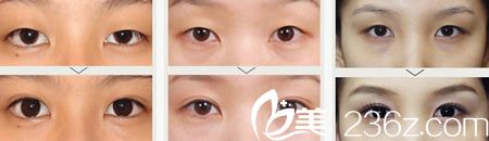 雙眼皮整形案例 雙眼皮整形案例