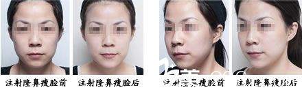 注射瘦臉整形案例 注射瘦臉整形案例