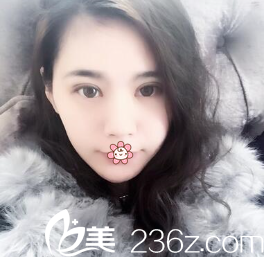 任在浩雙眼皮加開眼角術后半個月 任在浩雙眼皮加開眼角術后半個月