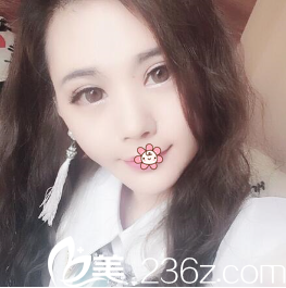 韓國i-Line整形外科雙眼皮術后39天 韓國i-Line整形外科雙眼皮術后39天