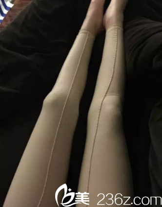 在北京壹加壹找王珂做腿部吸脂第13天效果