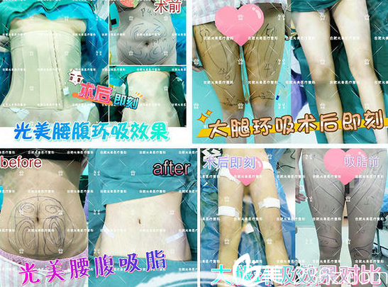 腰腹環(huán)吸效果好嗎，能讓腰變細(xì)嗎？看光美360環(huán)形吸脂真人案例