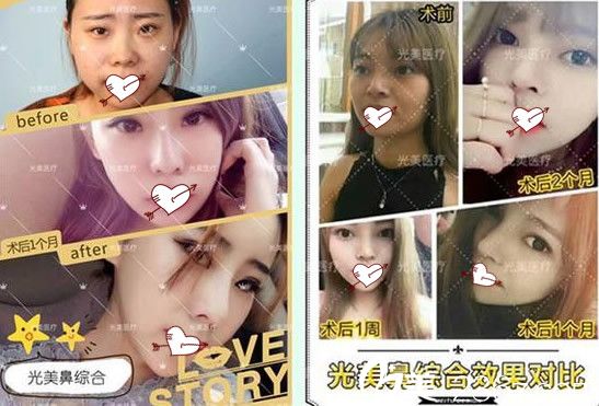 光美鼻綜合案例效果對比及恢復(fù)過程圖