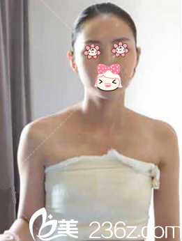 寧夏華美整形自體脂肪隆胸第6天 寧夏華美整形自體脂肪隆胸第6天