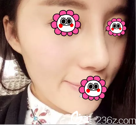 歪鼻多年終于讓我在北京米揚(yáng)麗格釋懷選擇巫文云修復(fù)因發(fā)小隆鼻效果好