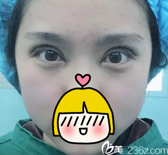 北京米蘭柏羽麗都做雙眼皮術(shù)后即刻樣子 北京米蘭柏羽麗都做雙眼皮術(shù)后即刻樣子