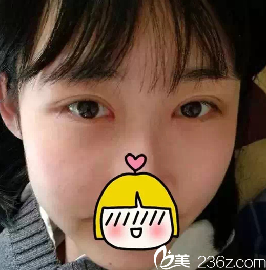 北京米蘭柏羽麗都于曉春給我做雙眼皮開眼角一個(gè)月效果 北京米蘭柏羽麗都于曉春給我做雙眼皮開眼角一個(gè)月效果