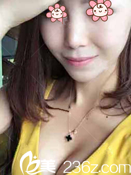 何林自體脂肪隆胸術(shù)后19天 何林自體脂肪隆胸術(shù)后19天