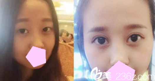 內(nèi)眥贅皮眼睛無神到呂梁麗都整形9月雙眼皮和韓式開內(nèi)眼角特價(jià)5980元