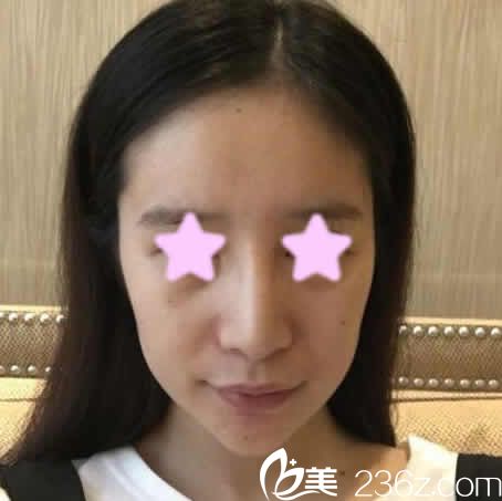 我在太原歐美蓮整形美容醫(yī)院做全臉自體脂肪填充前照片 我在太原歐美蓮整形美容醫(yī)院做全臉自體脂肪填充前照片