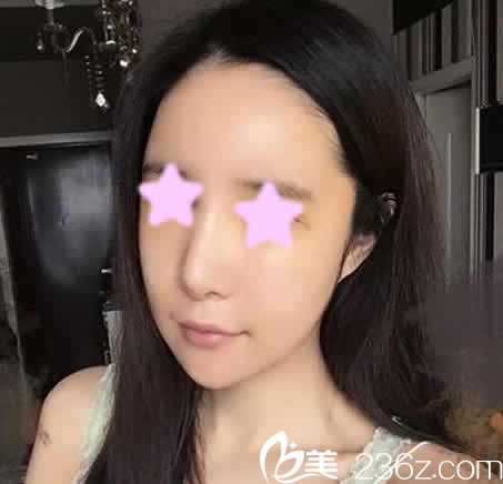 我在太原歐美蓮做面部自體脂肪填充術(shù)后第3天照片 我在太原歐美蓮做面部自體脂肪填充術(shù)后第3天照片