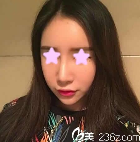 看到我在太原歐美蓮做全臉自體脂肪填充5天照片，這效果驚艷我了