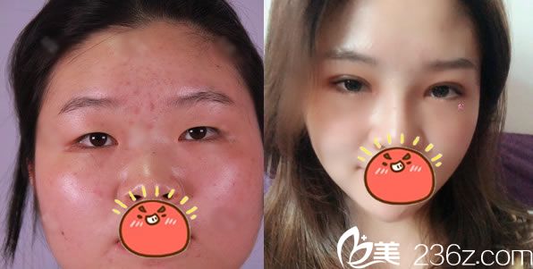 寧波珀悅金式倫做雙眼皮<span style=