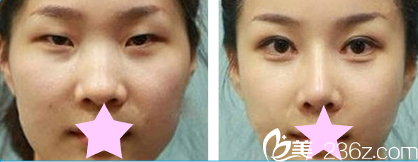 全切雙眼皮案例效果對(duì)比圖