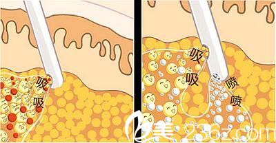 海南瑞韓整形美容醫(yī)院水動(dòng)力吸脂術(shù)