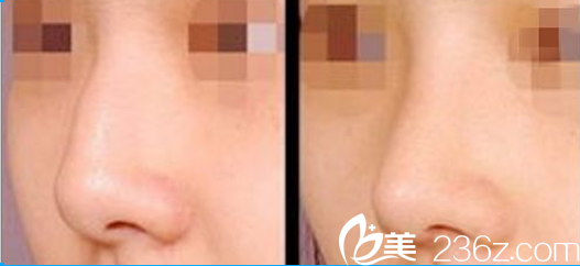 成都恒博鼻部整形對(duì)比圖