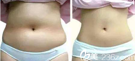 恒博整形醫(yī)院腰部吸脂手術(shù)案例