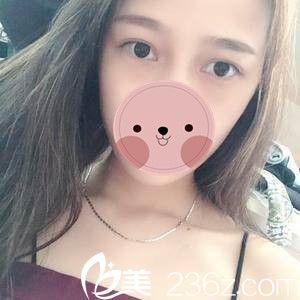 株洲宇芳姬整形李鶴醫(yī)生內(nèi)切祛眼袋真人案例，手術(shù)15天恢復過程記錄