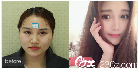 珠海艾瑞整形醫(yī)院祝小偉做的雙眼皮<span style= 珠海艾瑞整形醫(yī)院祝小偉做的雙眼皮<span style=