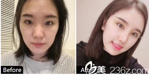 珠海艾瑞祝小偉做的做的隆鼻<span style= 珠海艾瑞祝小偉做的做的隆鼻<span style=