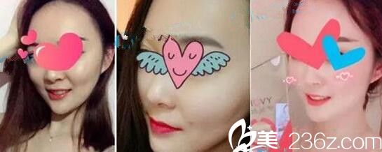 鄭州梨花雨做激光祛痘嫩膚案例