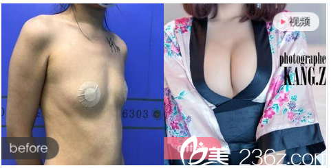 珠海艾瑞整形醫(yī)院祝小偉做的隆胸<span style= 珠海艾瑞整形醫(yī)院祝小偉做的隆胸<span style=