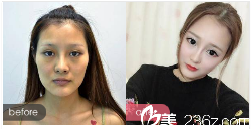 珠海艾瑞整形醫(yī)院熊學(xué)俊做的自體脂肪填充<span style= 珠海艾瑞整形醫(yī)院熊學(xué)俊做的自體脂肪填充<span style=