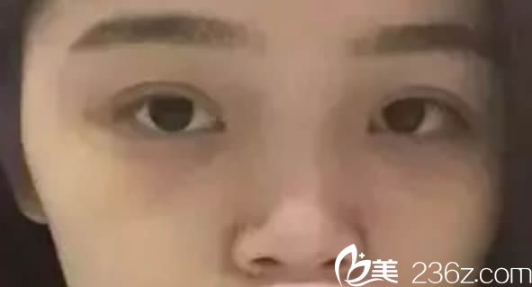 在福州臺江整形醫(yī)院隆鼻術(shù)前照 在福州臺江整形醫(yī)院隆鼻術(shù)前照