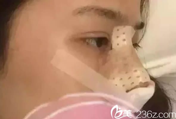 做完海鷗美鼻的術(shù)后即刻效果 做完海鷗美鼻的術(shù)后即刻效果