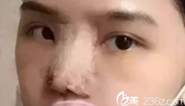 在福州臺江整形醫(yī)院做完隆鼻術(shù)后第4天的樣子 在福州臺江整形醫(yī)院做完隆鼻術(shù)后第4天的樣子