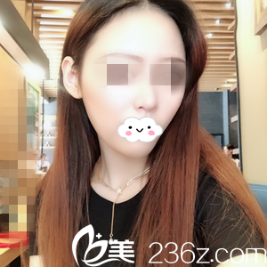 醫(yī)療美容醫(yī)院鼻綜合整形怎么樣？終于擺脫駝峰鼻的我一個月前后對比效果分享